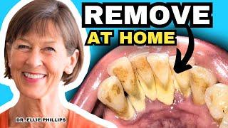 Tartar Removal At Home and How To Prevent Tartar