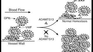 Thrombotic Thrombocytopenic Purpura (TTP)