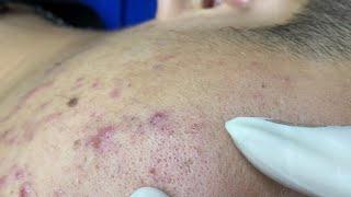 The best acne squeezing collection form Linh Mun Spa part 5