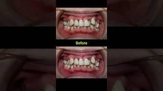 24 months braces for crooked teeth #braces #dentist #orthodontist #dental