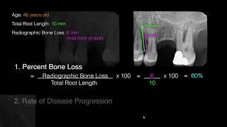 Periodontitis Grading Using Indirect Evidence