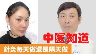 針灸每天做還是隔天做【保健養生】生生不息┃