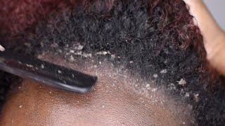 ITCHY DRY SCALP | SCRATCHING DANDRUFF | RAKING SCALP