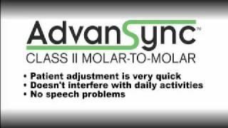 Advansync - Class II Molar-to-Molar: Part 1