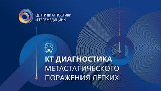 КТ диагностика метастатического поражения лёгких