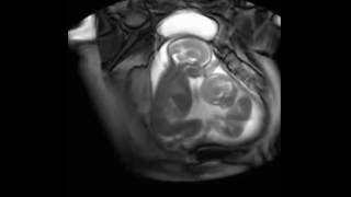 Twin Babies Caught On MRI Scan Fighting In Their Mother`s womb