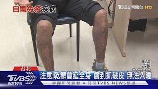 輕忽「自體免疫疾病」..症狀難以想像...醫警告別延誤就醫!｜十點不一樣20211210