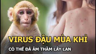 CẢNH BÁO: Virus đậu mùa khỉ có thể đã âm thầm lây lan!
