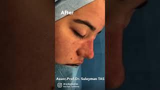 Rhinoplasty with CO2 Laser Treatment | Beautiful But Natural Nose