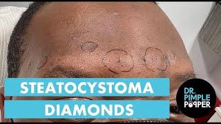 Dr Pimple Popper Mines For Steatocystoma Diamonds! 