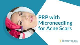 PRP with Microneedling for Acne Scars