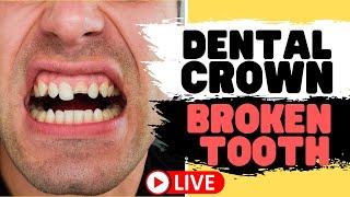 Tooth Crown Procedure | Front Tooth Crowns for Broken Teeth (LIVE)