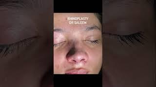 Rhinoplasty surgery for nose asymmetry.Ultrasonic rhinoplasty by dr Saleem.#rhinoplasty #nosejob