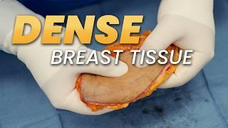 Dense Breast Tissue Got You Worried? Watch This Now