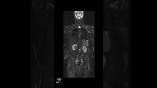 MRI – Whole Body Imaging w/Deep Resolve