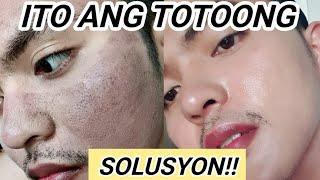 TOTOONG SOLUSYON SA PEKAS SA MUKHA! (Dark Spots, Melasma, etc.)