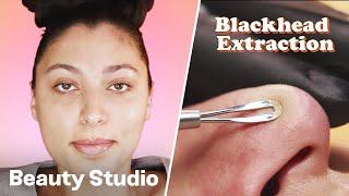 Blackhead Extraction Facial | Beauty Studio