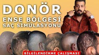 Donör (ense) Bölgesi Saç Simülasyon işlemi - Uzm.Est.Semih DENİZ