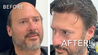 Chuck Alfieri Non-Surgical Hair Replacement For Men UNDETECTABLE HAIRLINE