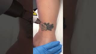 Tattoo Removal