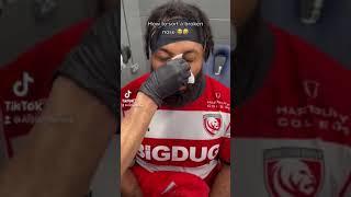 How to fix a broken nose!