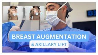 Breast augmentation and axillary lift with Dr. Zuri in Miami | Zuri Plastic Surgery