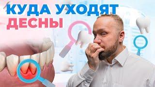 Рецессия десны. Что делать при опущении десны и как с этим бороться?