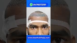 Hair Transplant Cost Of 2000 Grafts  #hairtransplantcost