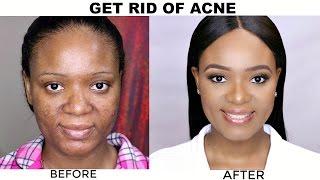 HOW TO GET A CLEAR SKIN + PRESCRIPTION MEDICATION FOR ACNE | OMABELLETV