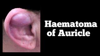 haematoma of the auricle