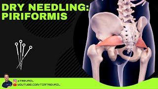 Dry Needling: Piriformis