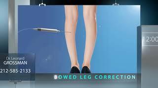 Bow Leg Minimally Invasive Corrective Surgery