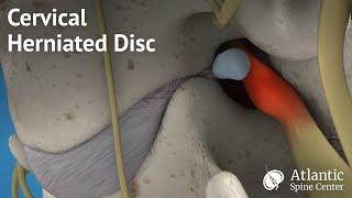 Cervical Herniated Disc