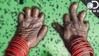 What Happens When You Get Leprosy?