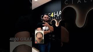 4000 Grafts Hair Transplant | Care4Hair Miami