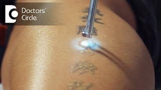 What is the cost estimate of Laser tattoo removal? - Dr. K Prem Anand