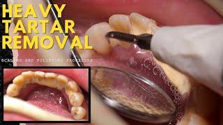 TARTAR removal procedure with teeth cleaning oral prophylaxis