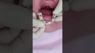 Dental implant’s All on 4 #shorts #smile  #impossible  #dentist #best #new #beautiful #shortvideo