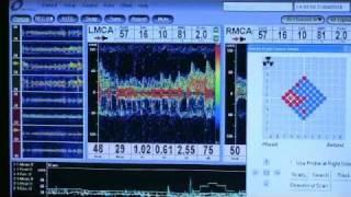 Multigon ROBOTOC Transcranial doppler