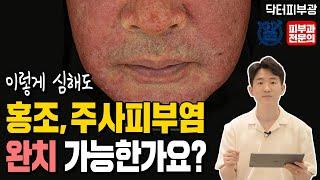 주사피부염 홍조 레이저 없이 완치 가능한가요? 가장 많이 하는 질문 5가지 - 피부과 전문의 닥터피부광