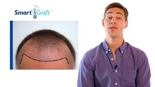 SmartGraft FUE Hair Transplantation Candidates