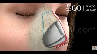 Let Down & Push Down Preservation Rhinoplasty, Nose Job Operation. Guncel Ozturk, M.D. #DRGO