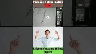 Live Varicocele Embolization Procedure #varicocele #shorts #viral #trending #reels #india #health