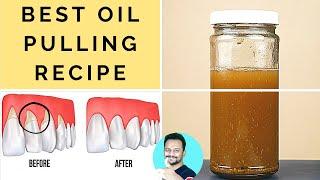 Heal Gingivitis, Receding Gums, Prevent Plaque & Tartar (World’s Best Oil Pulling Recipe)