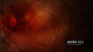 internal bleeding - 3d medical animation