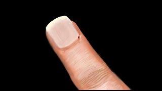 hangnail