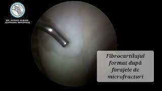 Reconstructie de Cartilaj cu metoda forajelor de Microfracturi - Dr. AHMAD ALQADI