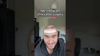 Hair transplant after 24hrs