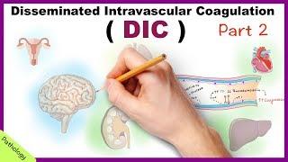 DIC: Disseminated Intravascular Coagulation / Part 2