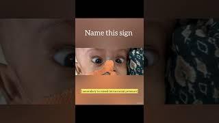 Sign seen in hydrocephalus #neurologicaldisorders #cns